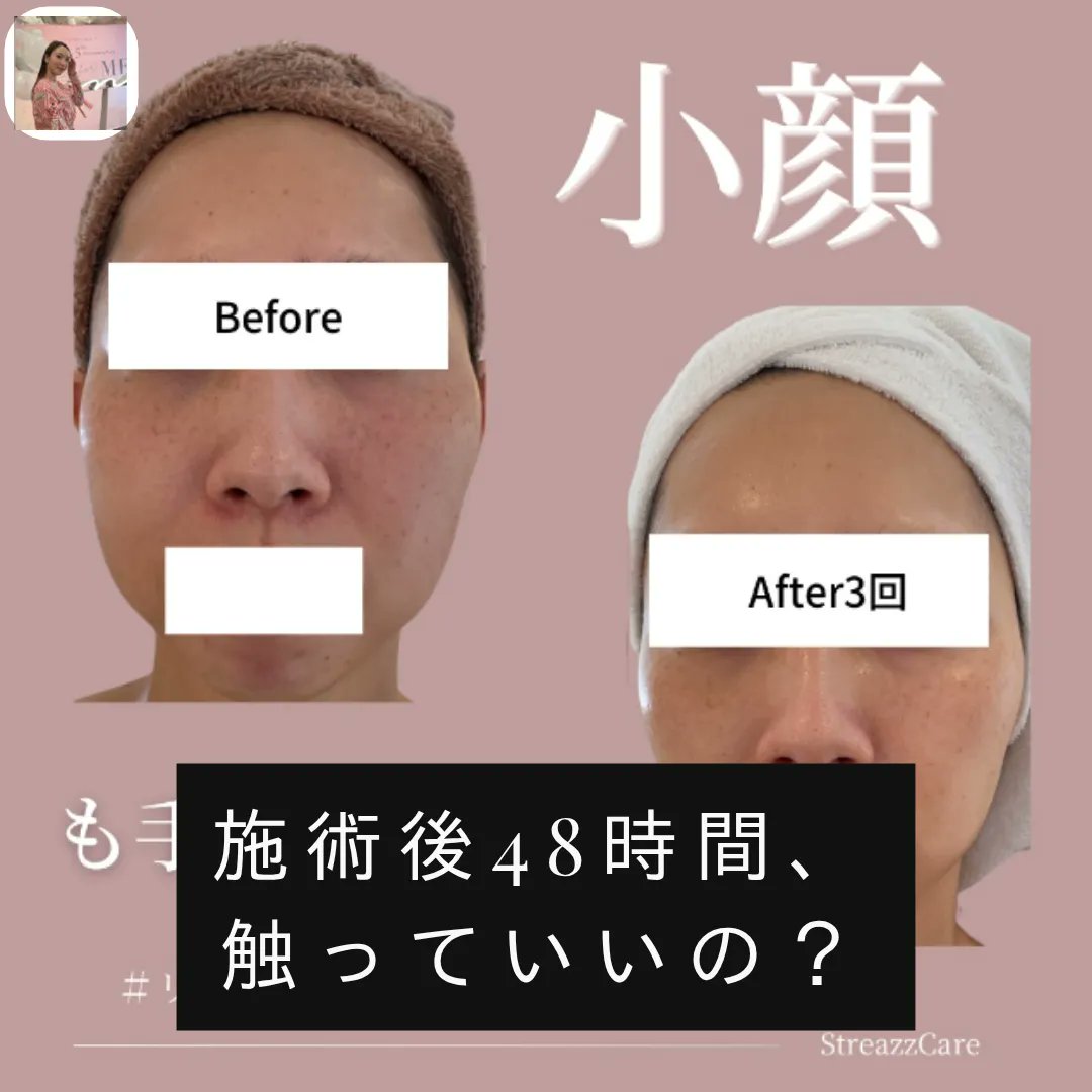streazzcare's tweet photo. 施術後48時間、鏡の前で手が止まる人多いです。
「触っていい？」「何を塗っていい？」——その不安、肌は修復の最中に受け取っています。

今日からできるのはシンプルに、水分補給＋刺激ゼロ。

ストリーズ・ケアでは、個別にアドバイスしています。

最新の情報をInstagramでチェック
#ストリーズケア https://t.co/hk4zDfLR1j