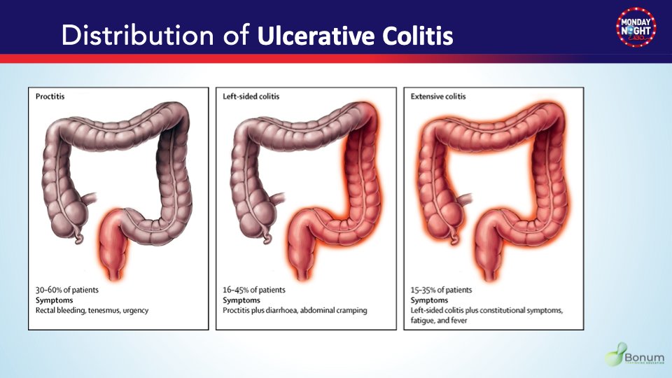 MarcelYibirin's tweet photo. @BarbaraOlendzki @AKohli_MD @joshsteinbergMD @JasonHouMD @EdwardLoftsu2 @BattatMD4IBD @JosephHabibi_MD @AimenKhanMD @BassiMehak @GutMD_ @AdamFayeMD @dunleavy_katie @kehutchins77 @KatieFalloonMD @NayantaraCoelho @AmJGastro @DrJordanAxelrad @DaniyalRaza92 @IBD_Houston 4-b UC in endoscopy
📢 UC + PSC → relative rectal sparing
 📢 Cecal patch = periappendiceal inflammation with distal UC (not Crohn’s skip lesions)
 📢 Backwash ileitis in severe pancolitis ≠ Crohn’s ileocolitis https://t.co/ku3CaU7a9z