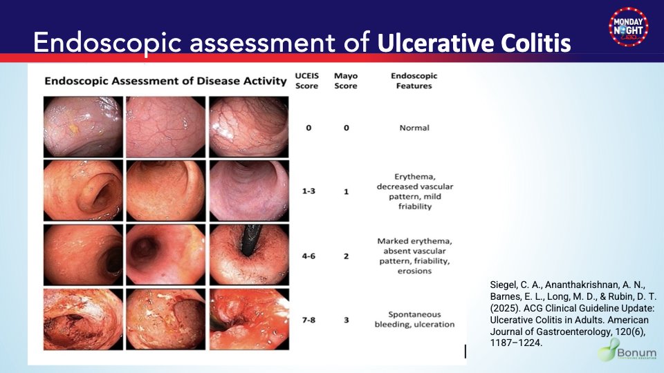 MarcelYibirin's tweet photo. @BarbaraOlendzki @AKohli_MD @joshsteinbergMD @JasonHouMD @EdwardLoftsu2 @BattatMD4IBD @JosephHabibi_MD @AimenKhanMD @BassiMehak @GutMD_ 4a  UC 🧠
📍 Hallmark sx: rectal bleeding 🩸
🔥 Superficial inflammation (mucosa + submucosa)
🔦  Starts in the rectum (exception👇)
➡️ Continuous proximal spread
📌 Extent:
• Proctitis = rectum only
• Pancolitis = extends beyond splenic flexure
📊 Endoscopic scores👇 https://t.co/5rZNoiyCeD