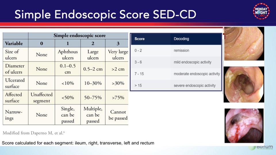 MarcelYibirin's tweet photo. @BarbaraOlendzki @AKohli_MD @joshsteinbergMD @JasonHouMD @EdwardLoftsu2 @BattatMD4IBD @JosephHabibi_MD @AimenKhanMD @BassiMehak @GutMD_ @AdamFayeMD @dunleavy_katie @kehutchins77 @KatieFalloonMD @NayantaraCoelho @AmJGastro @DrJordanAxelrad @DaniyalRaza92 @IBD_Houston @CathyLuMD @AroojMianMD @DCharabaty @IBDMD @DrSamirAShah1 @Samir_Grover @IBDimmunology @dr_fcalderaibd 5a-   Endoscopic scoring CD: SES-CD (slide👇)
🔤 Montreal classification in CD
🔤 A = Age at diagnosis
 📍 L = Location in GI tract
 ⚙️ B = Disease behavior https://t.co/oBkG8nC5RW