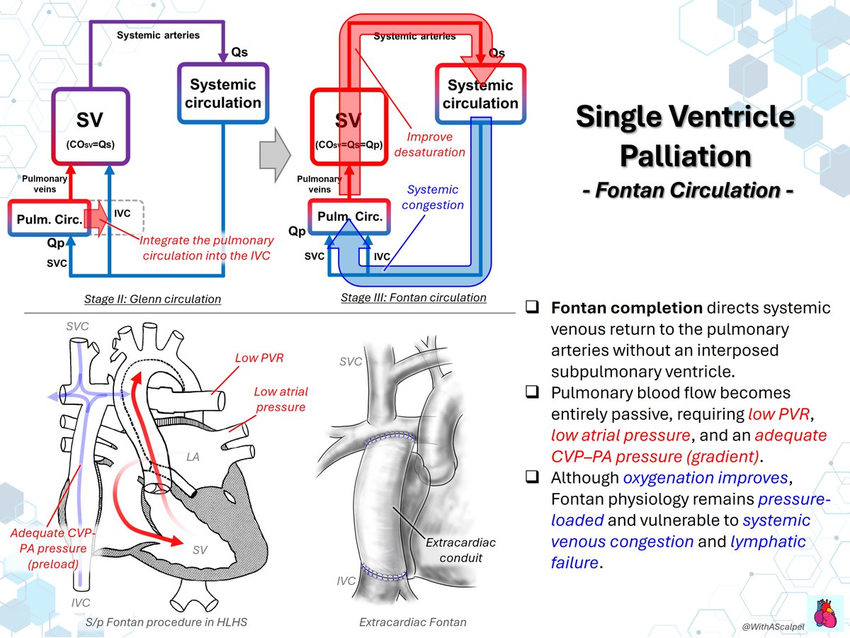 WithAScalpel's tweet photo. Fontan Pathway Diameter — Size, Flow Reserve, and Exercise Physiology🏃🌊

👉Fontan circulation directs systemic venous return to the PAs without a subpulmonary ventricle, making flow dependent on low PVR and an adequate CVP–PAP gradient.
👉The single ventricle supports systemic output through a venous pathway, where congestion and limited flow reserve become key constraints.
👉In 67 adults at exercise cath (mean age 30.4±7.9 yr), larger diameter correlated with less reserve: Qp −2.3%/mm, Qs −2.2%/mm, peak VO₂ −0.8%/mm.
(https://t.co/9JptVF39bg)

@MayoClinicCVS #JTCVS