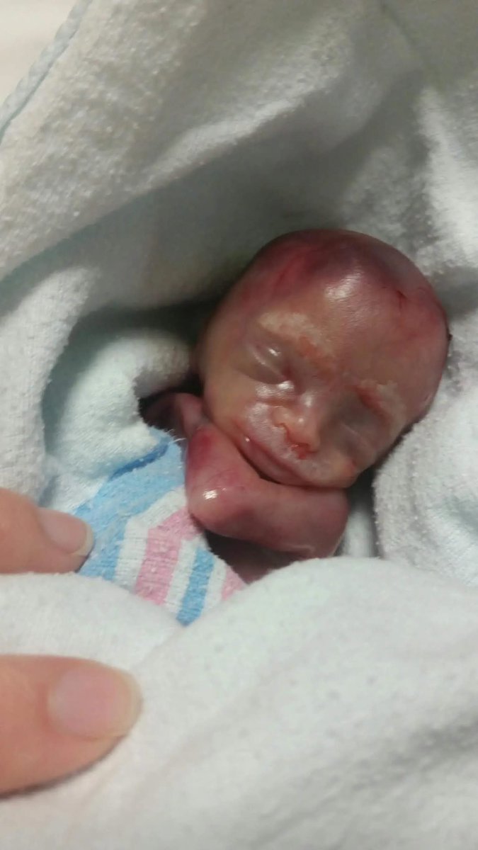 cantcancelmimi's tweet photo. Greyson lived for 2 hours after birth at 19 weeks. 

He had fingernails and toenails. 

This is a human being. 

This human being should not be chopped up in utero and vacuumed out. 

Abortion is not healthcare. https://t.co/Znk2OO3ud7