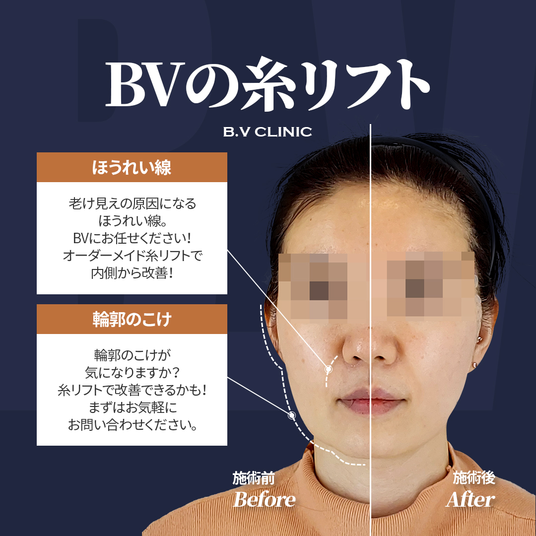 BVclinicjp's tweet photo. 老け見えの原因になりやすい
ほうれい線や輪郭のこけ感😱

BVではキードクター院長が
お一人おひとりの
お顔立ちやたるみの状態に合わせて、
オーダーメイドでデザインいたします✨

韓国糸リフトはBV💙

お問い合わせはこちら ！   
日本語対応中🇯🇵
https://t.co/f2nIlfa6ht 

#カンナム #渡韓美容 https://t.co/KxmgWQA1iY