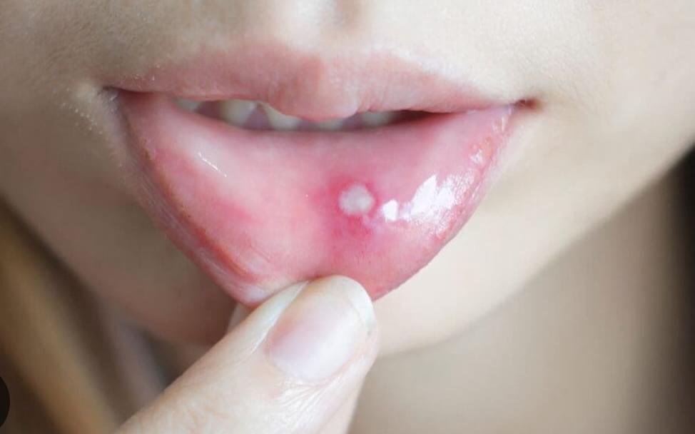 TrackYourHeart's tweet photo. Which of the following is NOT a common trigger for aphthous ulcers?
A. Stress
B. Trauma
C. Vitamin B12 deficiency
D. Human papillomavirus infection https://t.co/PcZxTjyCe9