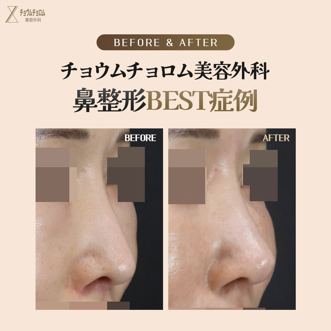 likefirst_jp's tweet photo. チョウムチョロムが教える
#整形手術 Before&After

目、鼻手術はすべて自信あります。
チョウムチョロム美容外科では’工場式’のような画一的な手術は行いません。
患者の目、鼻の形と年齢、シーズンなどの状態に合わせて
1：1パーソナライズで安全に手術を行う事をお約束します。
カウンセリングから手術、後管理まで代表院長1：1責任制で全ての過程を担当し、
嘘のない診療を行います。

#チョウムチョロム美容整形外科　#目整形　#鼻整形
#代表院長パーソナライズカウンセリング無料
#江南駅

#チョウムチョロム美容整形外科 #鼻整形 #小鼻縮小 #ナチュラル #鼻整形 #鼻再手術 #拘縮鼻 #韓国整形 #鼻中隔延長 #鼻鏧形レポ #鼻先 #鼻形 #美容整形 #形 #軟骨移植 #鼻整形レビュー #プチ軽形 #中年整形 #美意識 #美容オタク #美容整形外科 #形メイク #鼻尖形成 #軟骨移植 #鼻整形レポ #整形レポ #美容整形 #美容外科 #美容整形外科 #韓国ビューティー