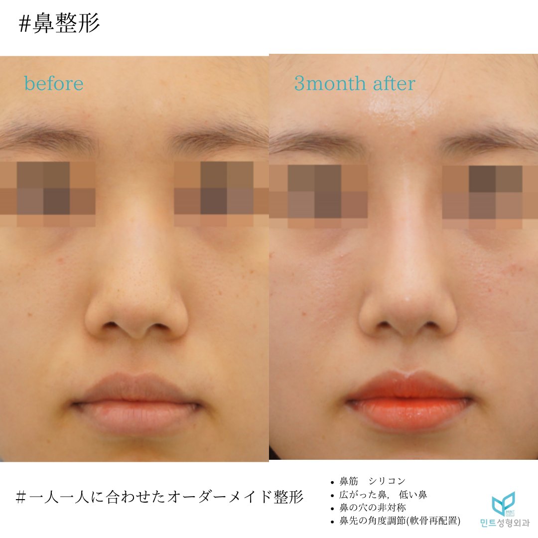 mintpskr's tweet photo. 🍀ミント整形外科🍀

👃鼻手術

✔鼻筋　シリコン
✔広が���た鼻矯正
✔鼻の穴の非対称矯正
✔鼻先の角度調節（軟骨再配置）

鼻の穴の非対称、鼻の広がりがスッキリ自然に✨
横顔もキレイになりました🩵

＃カンナム整形　＃鼻フル　＃自然な鼻
＃垢抜け　＃渡韓整形　＃広がった鼻 https://t.co/EvWJASZ5Ru