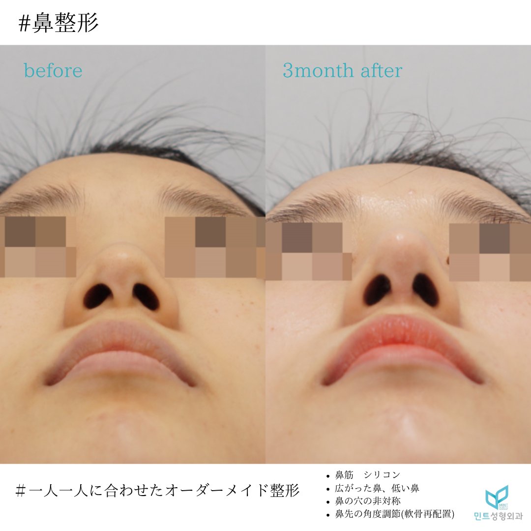 mintpskr's tweet photo. 🍀ミント整形外科🍀

👃鼻手術

✔鼻筋　シリコン
✔広が���た鼻矯正
✔鼻の穴の非対称矯正
✔鼻先の角度調節（軟骨再配置）

鼻の穴の非対称、鼻の広がりがスッキリ自然に✨
横顔もキレイになりました🩵

＃カンナム整形　＃鼻フル　＃自然な鼻
＃垢抜け　＃渡韓整形　＃広がった鼻 https://t.co/EvWJASZ5Ru