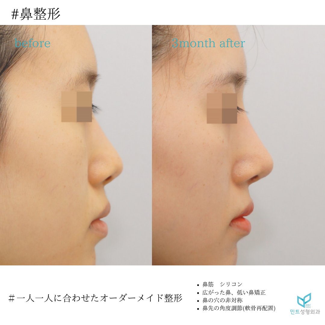 mintpskr's tweet photo. 🍀ミント整形外科🍀

👃鼻手術

✔鼻筋　シリコン
✔広が���た鼻矯正
✔鼻の穴の非対称矯正
✔鼻先の角度調節（軟骨再配置）

鼻の穴の非対称、鼻の広がりがスッキリ自然に✨
横顔もキレイになりました🩵

＃カンナム整形　＃鼻フル　＃自然な鼻
＃垢抜け　＃渡韓整形　＃広がった鼻 https://t.co/EvWJASZ5Ru