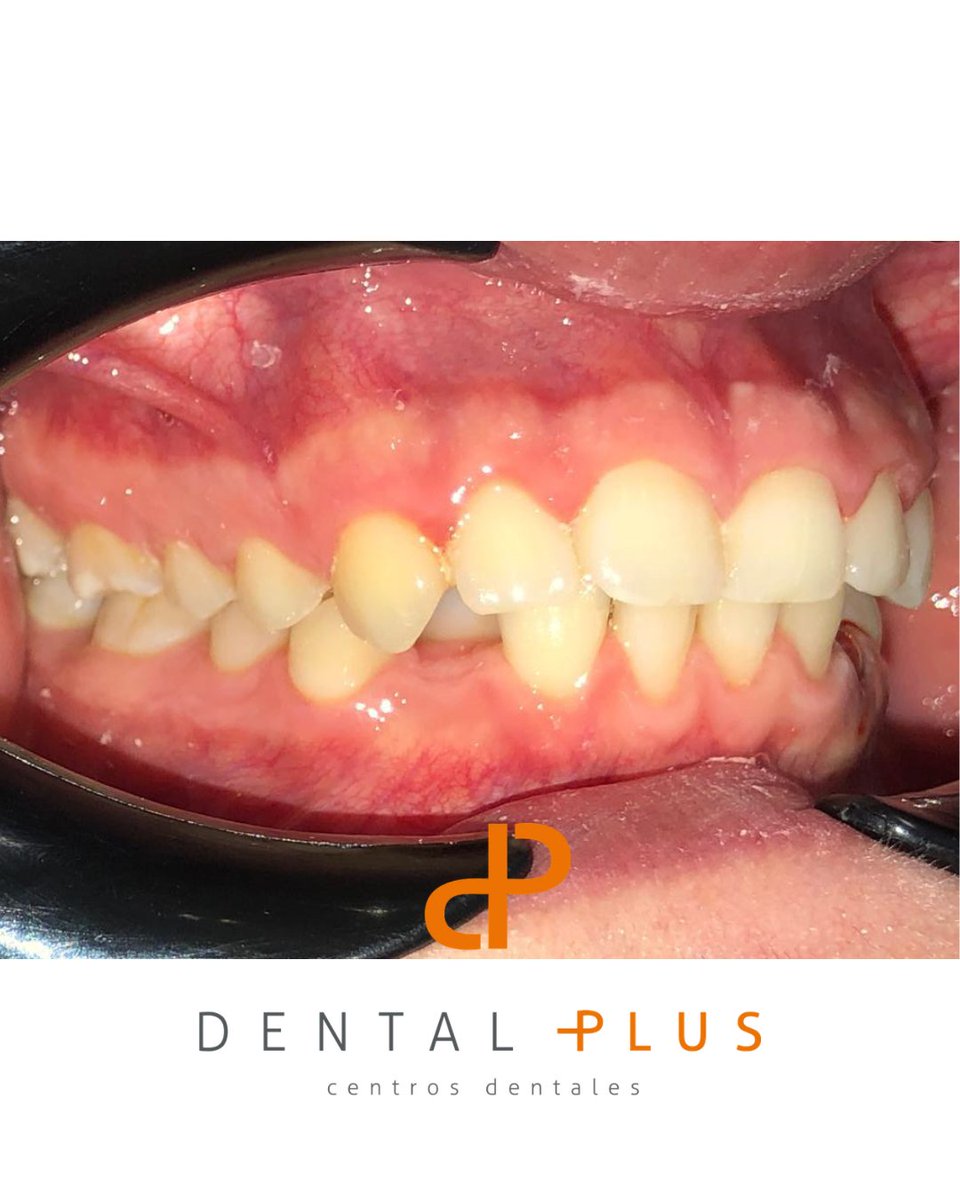 DentalplusPLUS's tweet photo. De tener un colmillo “perdido” a sonrisa perfecta. 🦷✨
Este adolescente no tenía espacio para que el canino volviera a su sitio.
Se realizó extracción estratégica de premolar para crear el espacio necesario y reposicionar la pieza.
El resultado final solo hay que verlo 💯 https://t.co/1dBibm2cEX