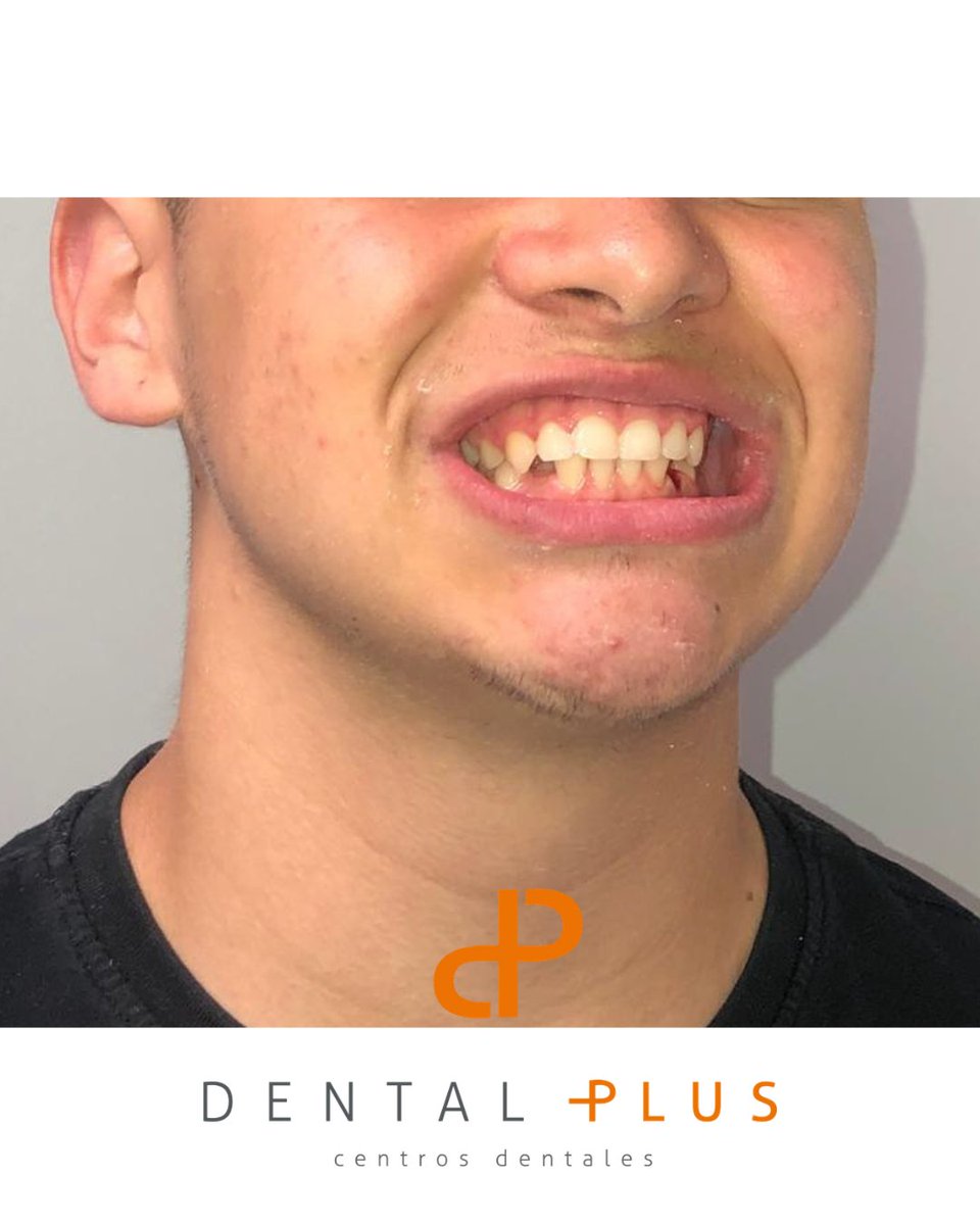 DentalplusPLUS's tweet photo. De tener un colmillo “perdido” a sonrisa perfecta. 🦷✨
Este adolescente no tenía espacio para que el canino volviera a su sitio.
Se realizó extracción estratégica de premolar para crear el espacio necesario y reposicionar la pieza.
El resultado final solo hay que verlo 💯 https://t.co/1dBibm2cEX