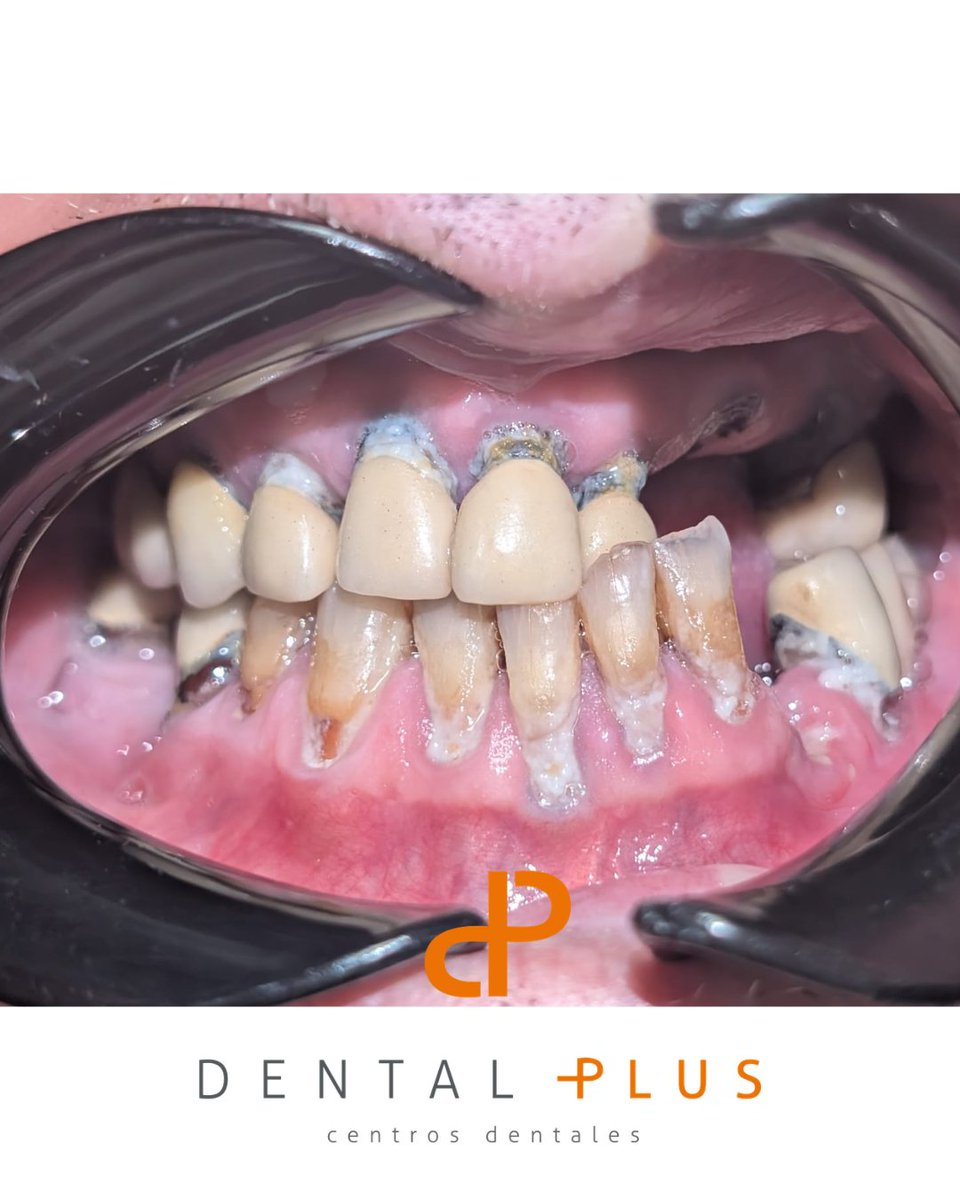 DentalplusPLUS's tweet photo. De una dentadura comprometida a una sonrisa fija, funcional y estética en un solo día🙌
Realizamos una rehabilitación completa con 8 implantes y una prótesis fija
Por la mañana realizamos la cirugía, y por la tarde ya estaba disfrutando de su nueva sonrisa 😄 https://t.co/dmBW7mOa1L