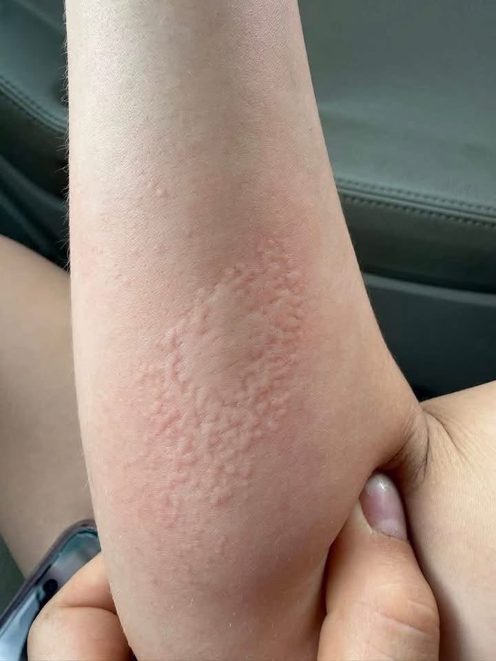 kaepyoooon30's tweet photo. 请解释一下😭我和我炮友在酒店过了一天。今天醒来时，我胳膊上就有这个了。它不痒但会烧灼感，而且我一碰手它就扩散了。有人知道这是什么吗？ https://t.co/FVI7ko4jWj