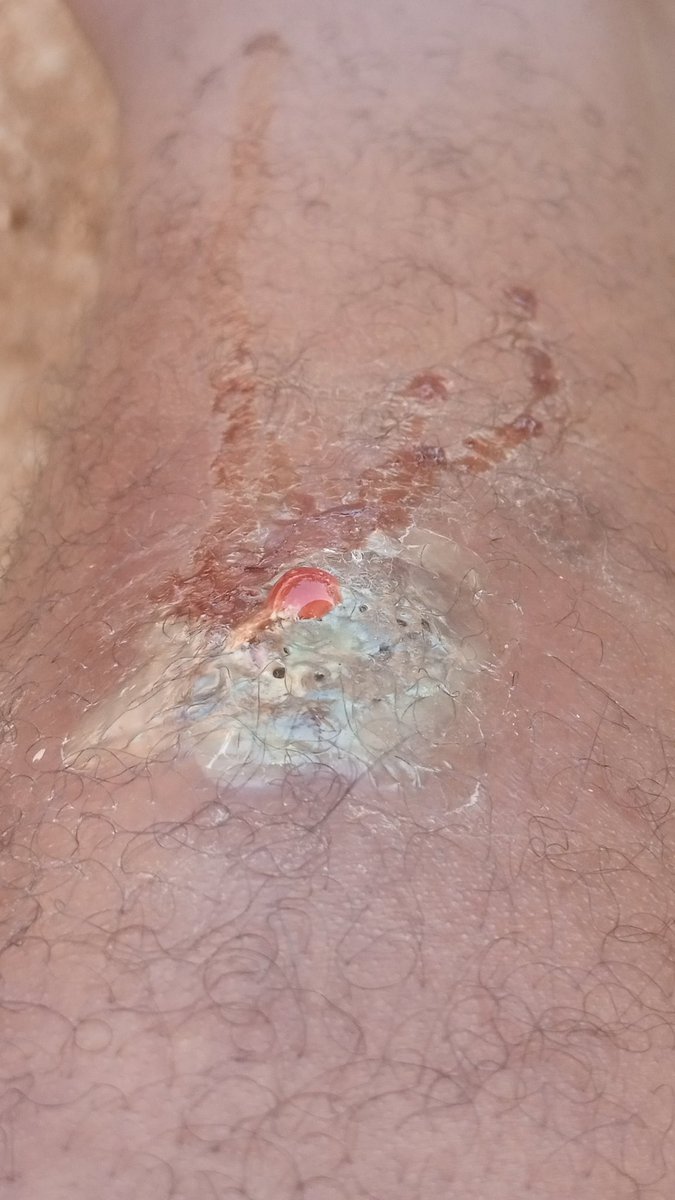 MusimentaP76100's tweet photo. Consider donating to help me on the treatment bills.
$150 needed.https://t.co/QUUPN885c5 https://t.co/lvYQM8I1NR
