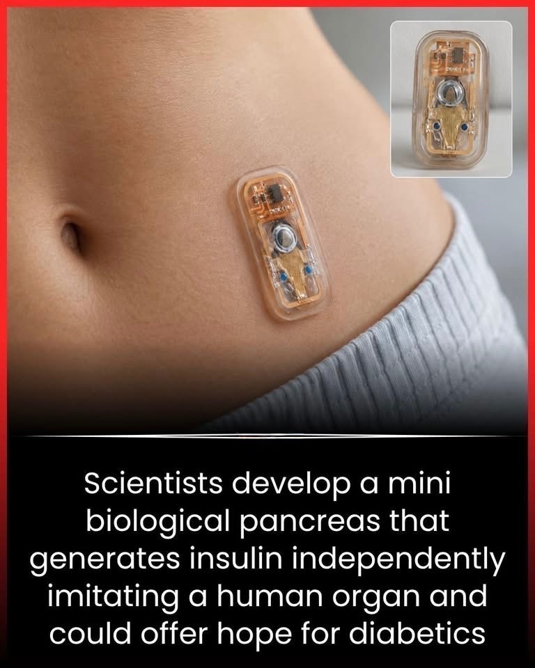 NextScience's tweet photo. 🚨 SCIENTISTS JUST CREATED A MINI PANCREAS THAT MAKES INSULIN ON ITS OWN 

What if people with diabetes no longer needed daily insulin injections in the future?

Scientists have now developed a tiny lab-grown “mini pancreas” that can naturally produce insulin just like a real human organ. The bioengineered cells can actually sense rising sugar levels and respond by releasing insulin automatically.

Researchers say this breakthrough could completely change the future of diabetes treatment. While it’s still being tested in laboratories and not yet ready for public use, experts believe this technology may one day help replace damaged organs with living lab-grown tissues.

A future where the body heals itself instead of depending on constant medication may be closer than we think… and this could be one of the biggest medical breakthroughs of our time. 

Source:
National Institute of Diabetes and Digestive and Kidney Diseases. Bioartificial pancreas and regenerative medicine research.