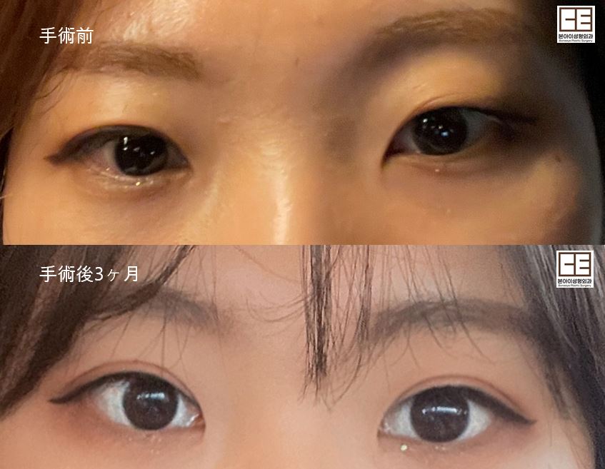 boneeyeps's tweet photo. 💖ボナイ整形外科 目整形💝
▶️切開 再手術
▶️目付き矯正
▶️目頭切開
気になることございましたらいつでも
公式LINEにご連絡ください💌
https://t.co/L32y87w6Yn

再手術も得意とする病院です！！
ボナイ整形外科で大変🫶🏻

#韓国　#整形 #ボナイ整形外科 #切開 #二重  #再手術 https://t.co/d4tlvC7KVO