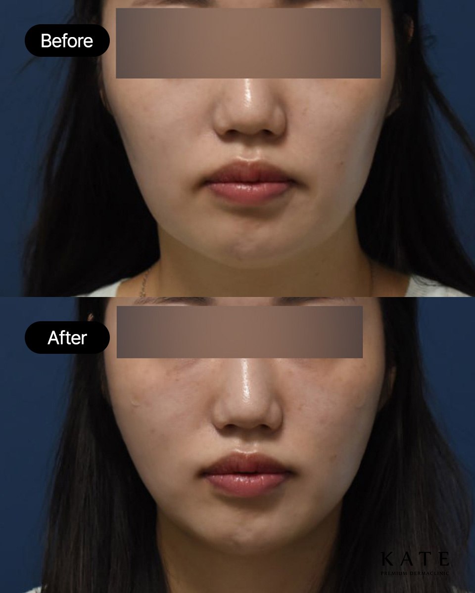 kate_clinic's tweet photo. <中顔面リフトBefore&After>

・施術内容
糸リフト(顎ライン)+ヒアルロン酸フィラー(横頬)

・施術のポイント
口横やフェイスラインがたるみ、頬の部分は窪んでいるため全体的に面長に見えているタイプです。
たるんでいる部分は糸リフトで上の方向に持ち上げてすっきりとリフトアップし、横頬の窪みはフィラーを少量注入して輪郭をなめらかに仕上げました。

口横やフェイスラインは脂肪が付きやすい部分のため、脂肪が多い方は脂肪溶解注射や脂肪減少効果のあるチューンライナーを一緒に受けるとよりすっきりとしたラインに近づけます✨