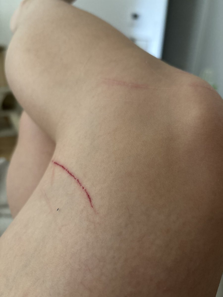 lookingforasoul's tweet photo. le même qui m’a fait cette blessure de guerre https://t.co/ClLNATdoEM