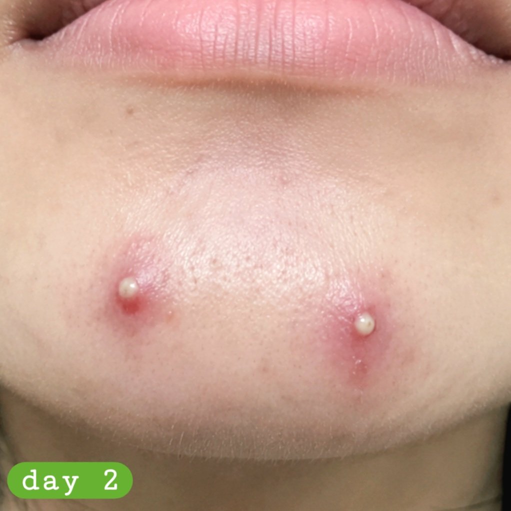 i8kyoiv's tweet photo. aku tuh kalo jerawatan selalu di dagu dan lebih sering jerawat batuu

terus aku iseng nyari di tiktok dan nyoba pake masker mugwort. SUMPISASS besoknya langsung matenggg

selama aku pake ini tuh rasanya ada cekat cekitnya gitu, tapi keesokan harinya udah ngga https://t.co/Mgwo5VLZjl