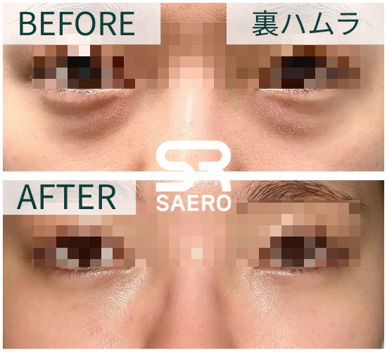 saerops's tweet photo. ＼#セロ美容外科🌻7月イベント開催🌻／

🩷大人気施術を特別セット価格でご案内🩷

【裏ハムラ】-目の下脂肪再配置
💎150万ウォン→110万ウォン
【表ハムラ】-下眼瞼
💎225万ウォン→150万ウォン
　　＋
当イベントで手術を受けられた方限定で、
【リジュランアイ1㏄】プレゼント✨

✅ 老けて見える
✅ 疲れて見える
✅ 眠そうな印象になる
✅お化粧でクマが隠し切れない

そんなお悩みは、目の下を整えることで改善できる場合があります✨

自分には何が適応かわからない><という方も、
お気軽にLINEでお問い合わせください😊
スタッフが丁寧にご案内いたします💙

📩お問い合わせ＆ご予約はコチラ
https://t.co/sC9TKjxWvs

#目の下脂肪再配置 #裏ハムラ #下眼瞼 #表ハムラ #セロ美容外科 #症例写真 #韓国 #渡韓 #整形