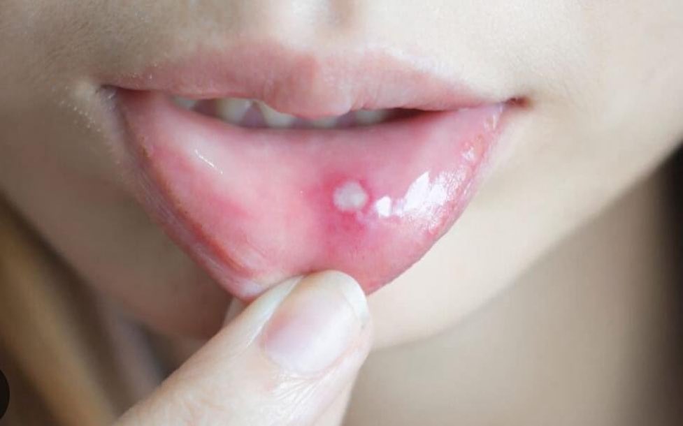 Doctors__squad's tweet photo. Q. This painful mouth ulcer is most commonly linked to the deficiency of which vitamin? 🤔
    A) Vitamin A
    B) Vitamin B12
    C) Vitamin D
    D) Vitamin K https://t.co/giRmzVMYju