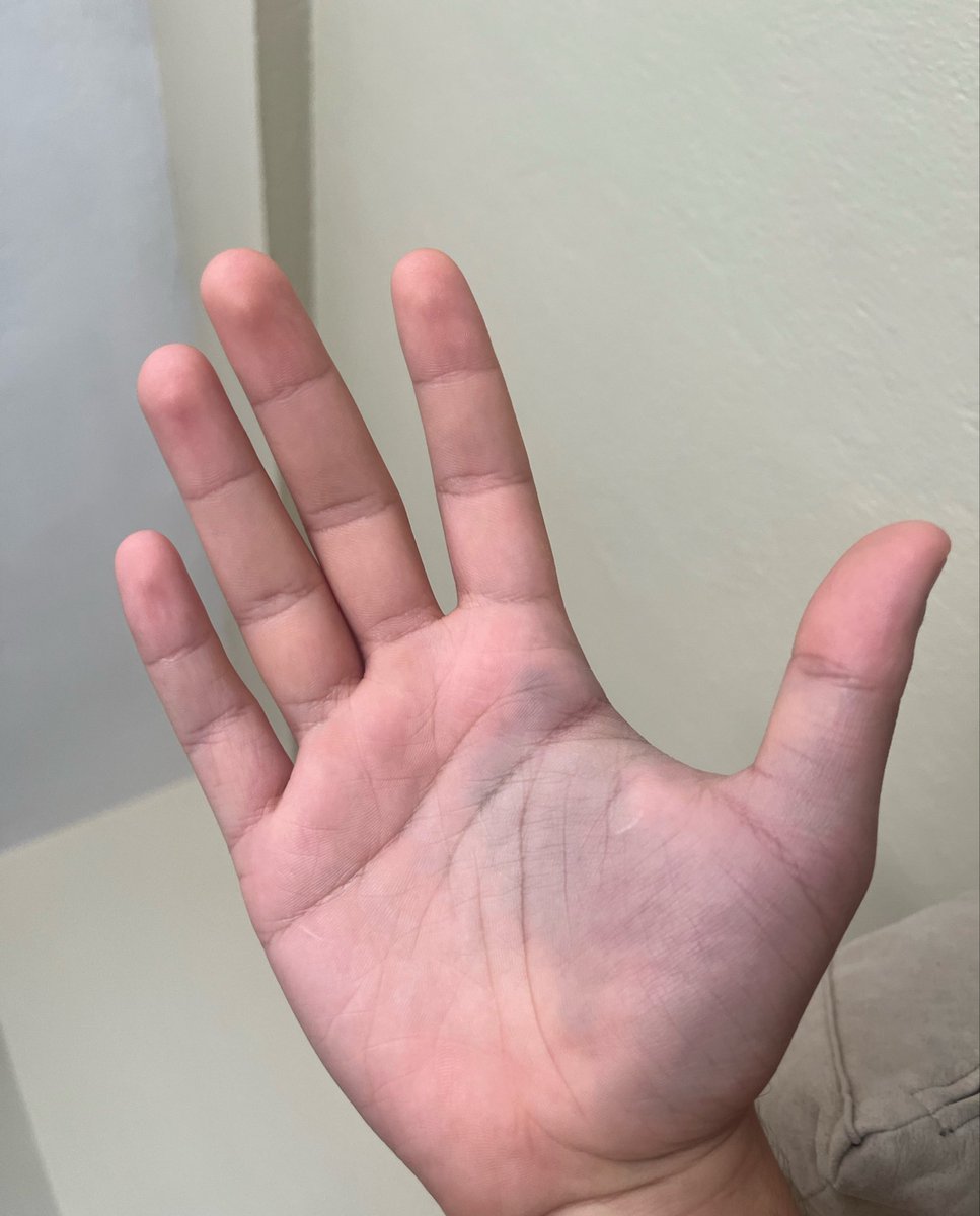 matwevholosko's tweet photo. @hasbelkader @hatewatchlover Yarrak kalmazsın geçen hsde baş parmağa diklemesine top geldi 1 ayı geçti zora ki iyileşmeye başladı şuan,güç kuvvetle alakası yok beklemediğin anda ters bi hareketle bu hale geliyor ztn https://t.co/jzxrlRvg2M
