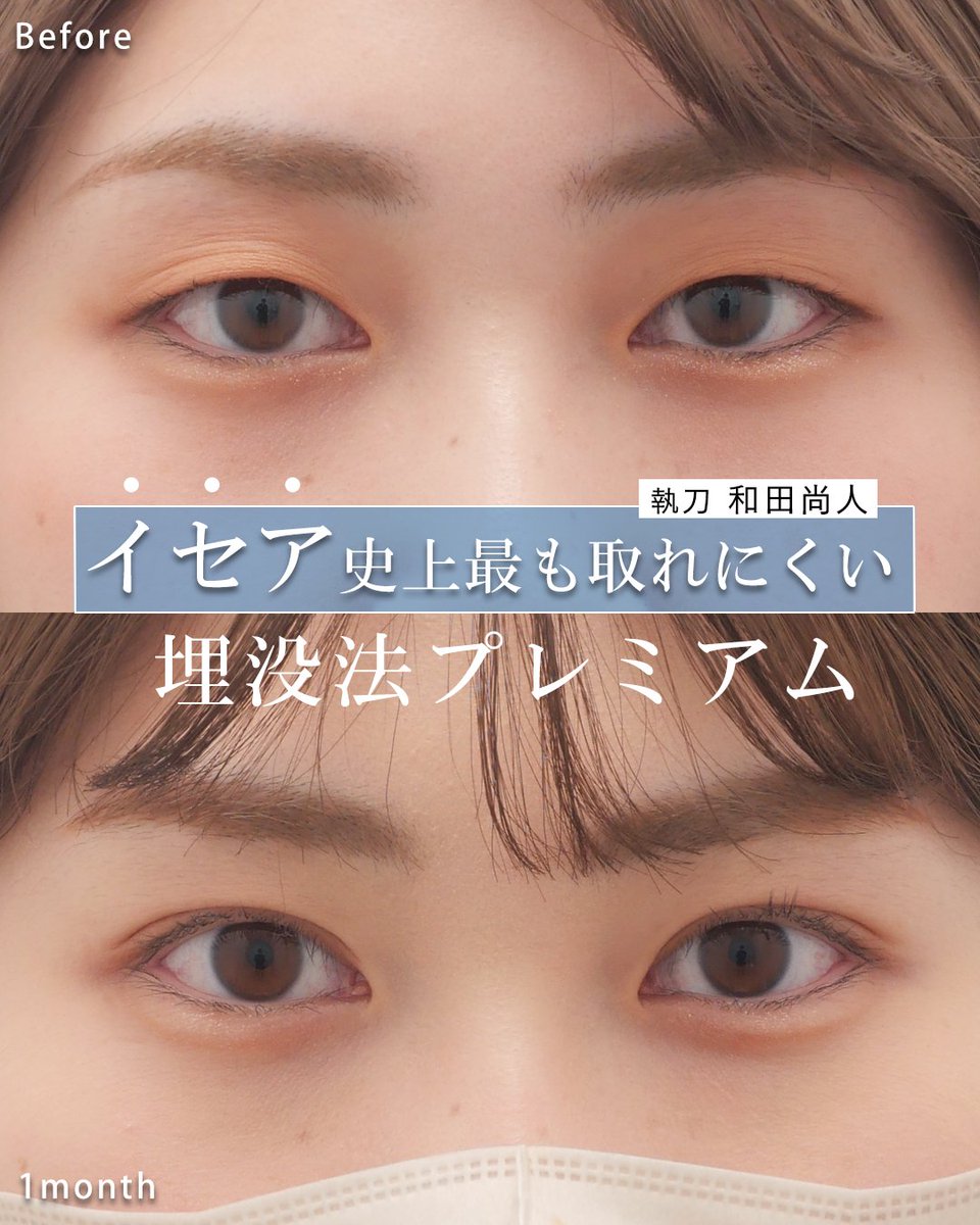 wada_isea's tweet photo. アイテープを約5年間続けていた一重の患者様。
複数の折れ癖や皮膚のかぶさりを考慮し、目頭は無理に広げず、中央から目尻へ自然につながる二重ラインをデザインしました。埋没法で折れ目が整理され、まつ毛の生え際もすっきり。二重整形は幅だけでなく、まぶた全体のバランスを見極めることが大切です https://t.co/Z6nWKg3N5N