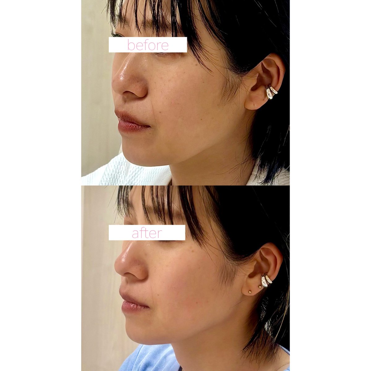 CLINIC_EMMA's tweet photo. エラとほうれい線、という王道部位の輪郭美人ボトックス✨
お顔全体のバランスまで整えるから、笑顔の可愛さ、何倍にもアップ😍
 #銀座美容クリニック #デザインボトックス #輪郭美人ボトックス #エラボトックス #ほうれい線改善 https://t.co/N4MXAHHq9f