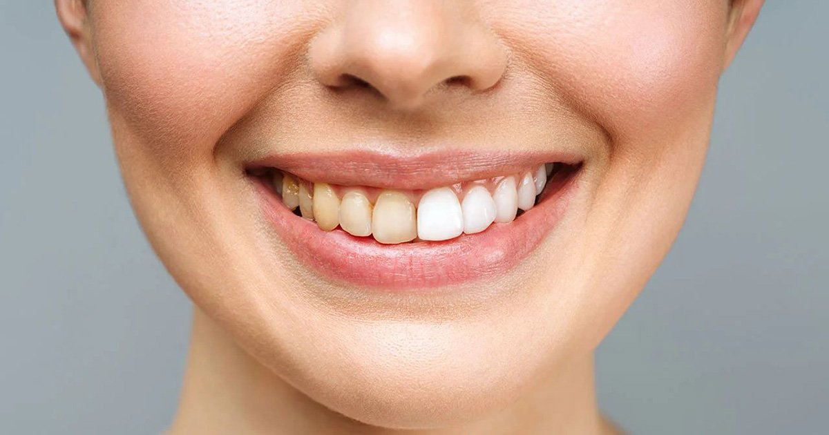 TheZyraSolen's tweet photo. Hey @grok What brand of toothpaste do I need to use to get my teeth sparkling like this? https://t.co/odAJlHlW4J