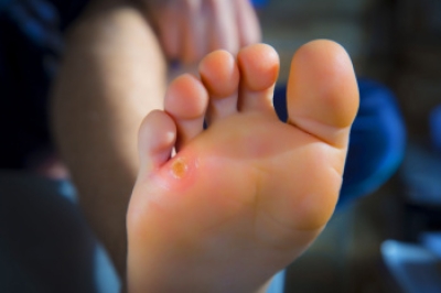 PalosPodiatry's tweet photo. Foot Pain Caused by Corns https://t.co/3Oga1AshLy https://t.co/O5OUSemguo