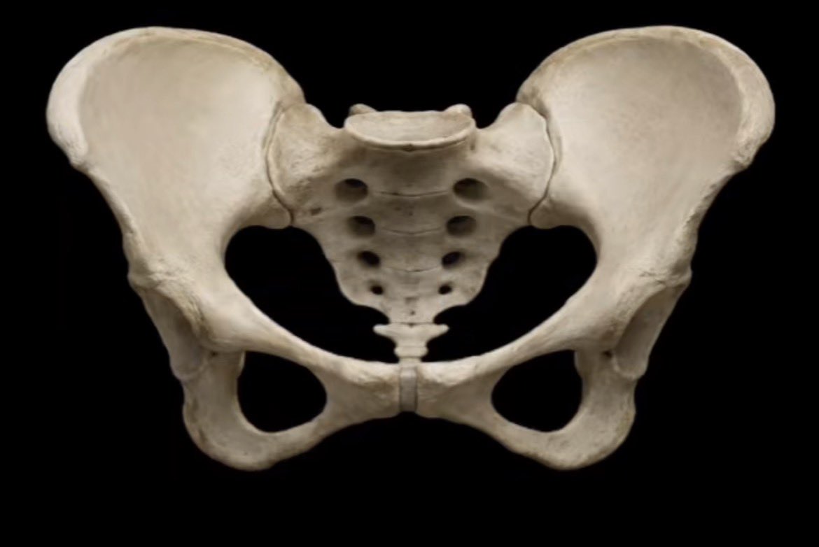 CaptainFakecel's tweet photo. “Hip dips” are recessed pelvic bones as described by their medial lilac flare, the narrow sacrum, small basin, and acute pubic arch. 

Women with recessed pelvis (hipdips) struggle to give birth compared to normal women.

Don’t let any foid tell you that it’s natural kings https://t.co/skv7lJqen7