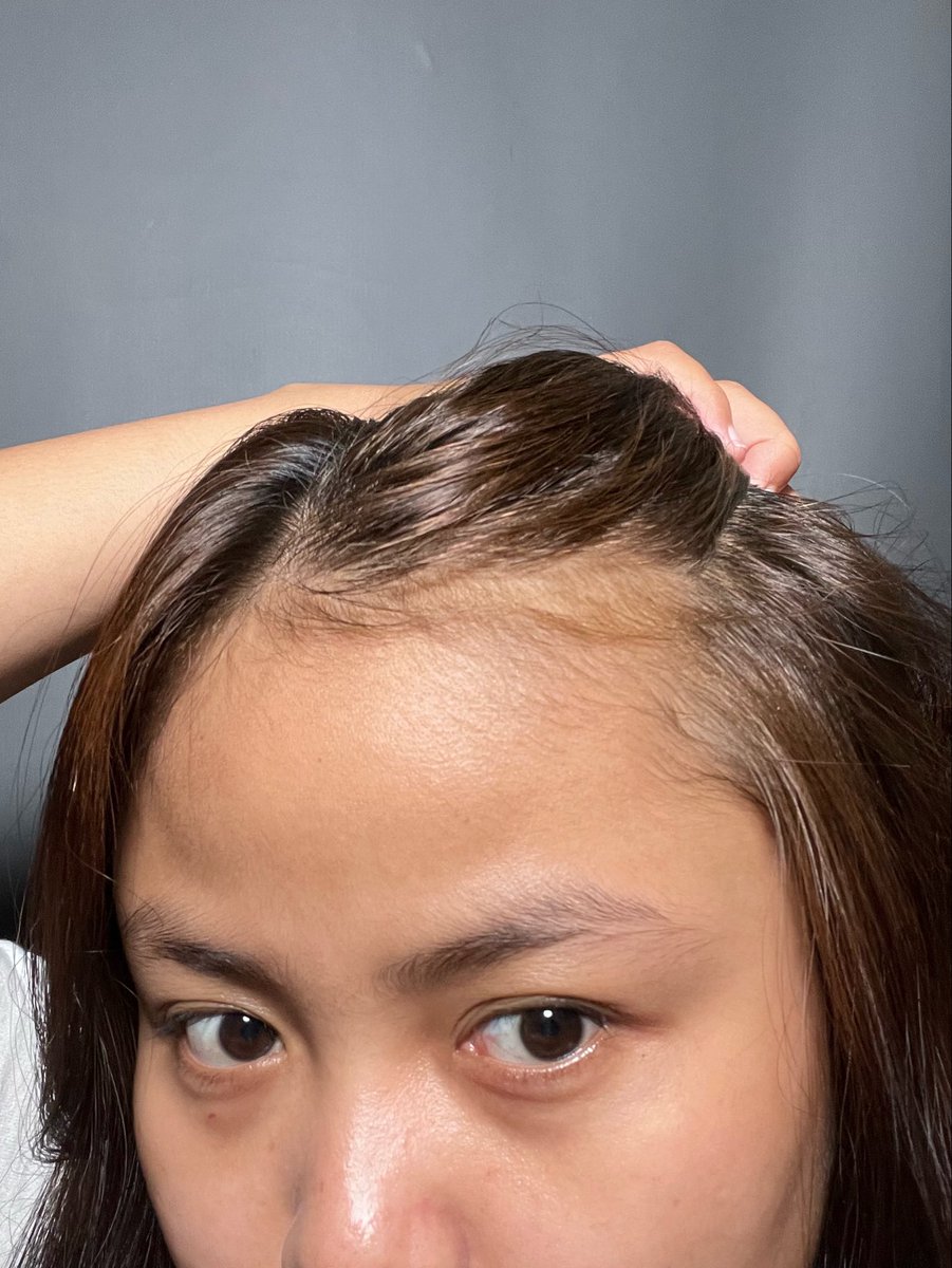 tarochococookie's tweet photo. Siapapun yang punya masalah sama rambut lagi rontok parah,tipis bahkan hampir botak, aku bakal share haircare yg aku pake dan emang sengaruh itu hasilnya! 

before                           after✨ https://t.co/1MIfLdGyPx