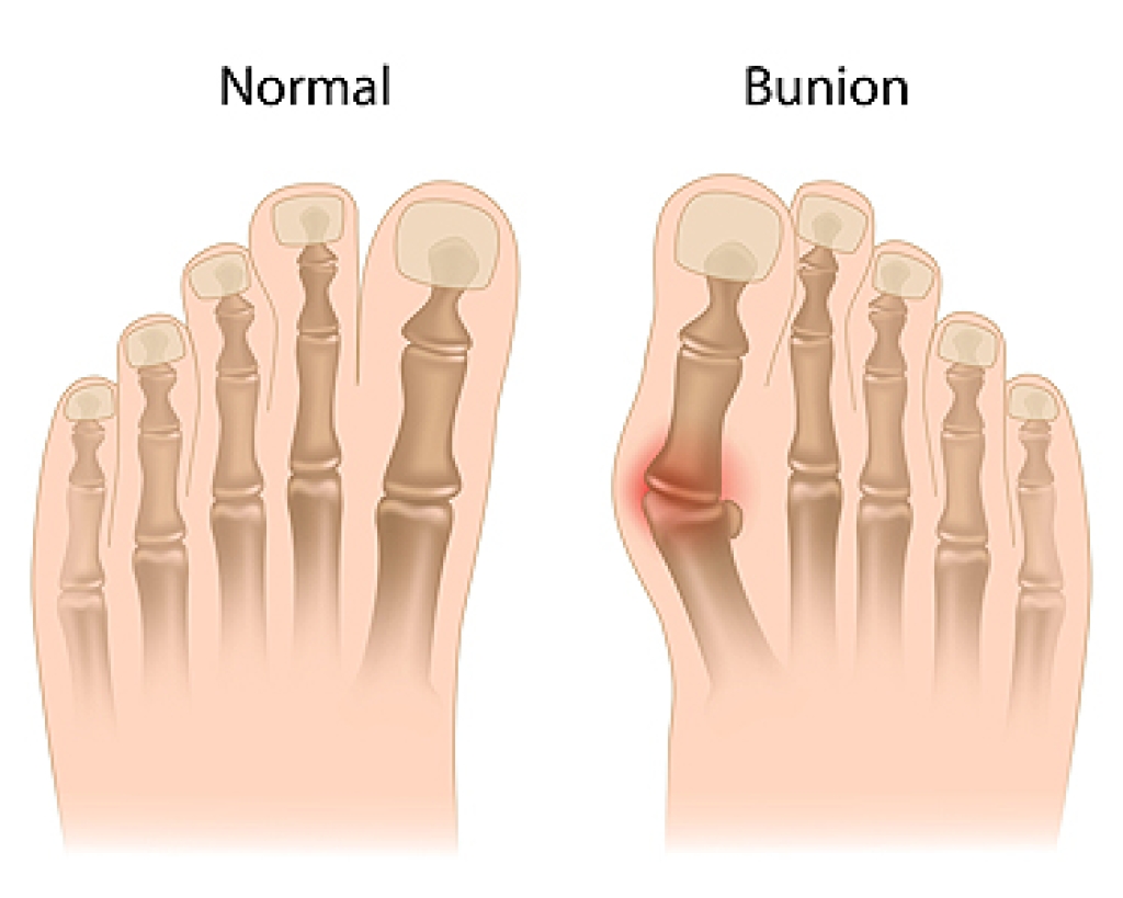 donaldtupperdpm's tweet photo. Bunion Basics and Foot Changes https://t.co/diquslmzbd https://t.co/IqhKOF06x9