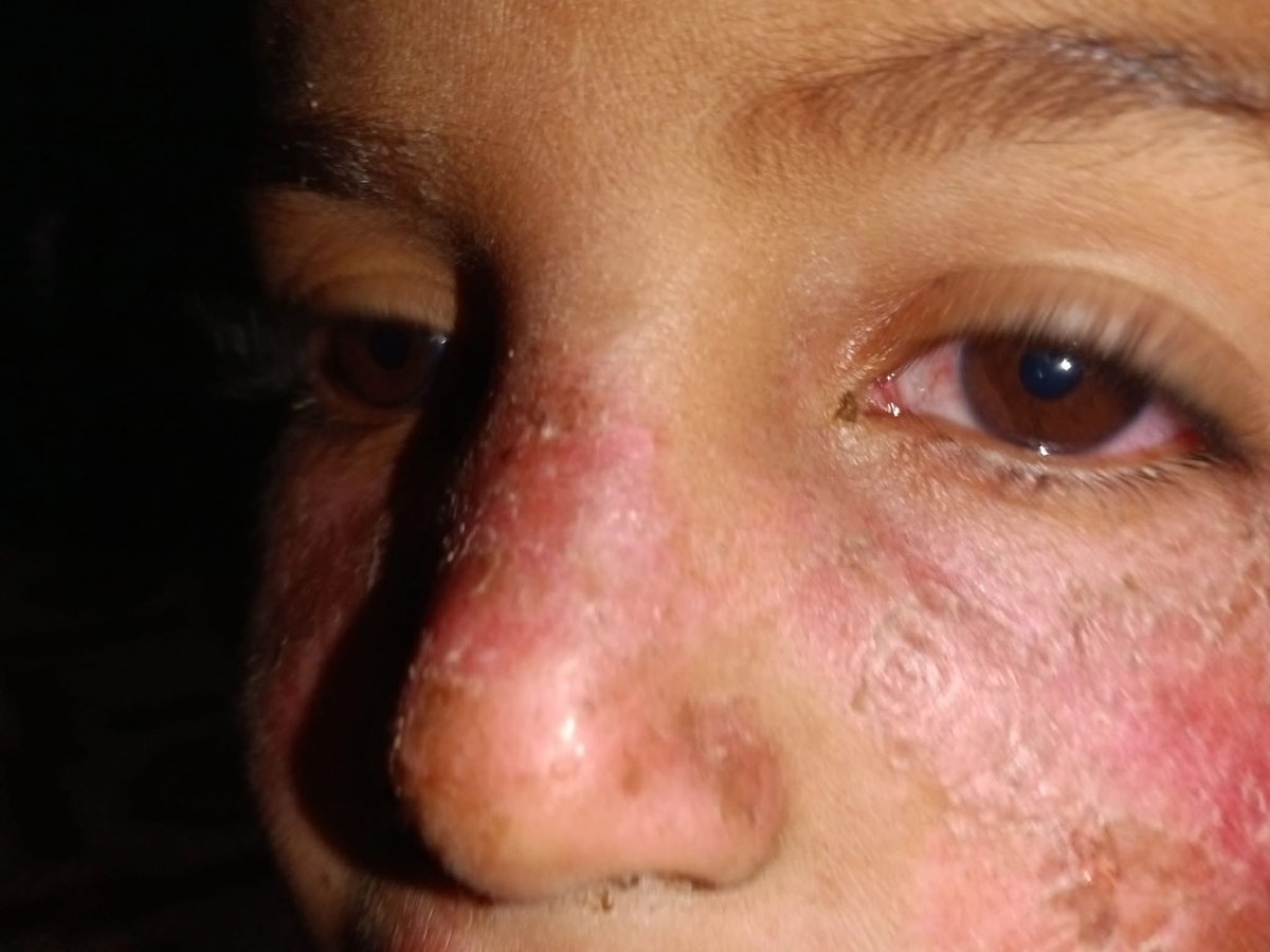 Dr_SaebGaza's tweet photo. My little brother's face was burned, and even his eyesight was affected by the burn. The pain is severe My brother needs your support. 😞🚨 https://t.co/kvfm0tAESw