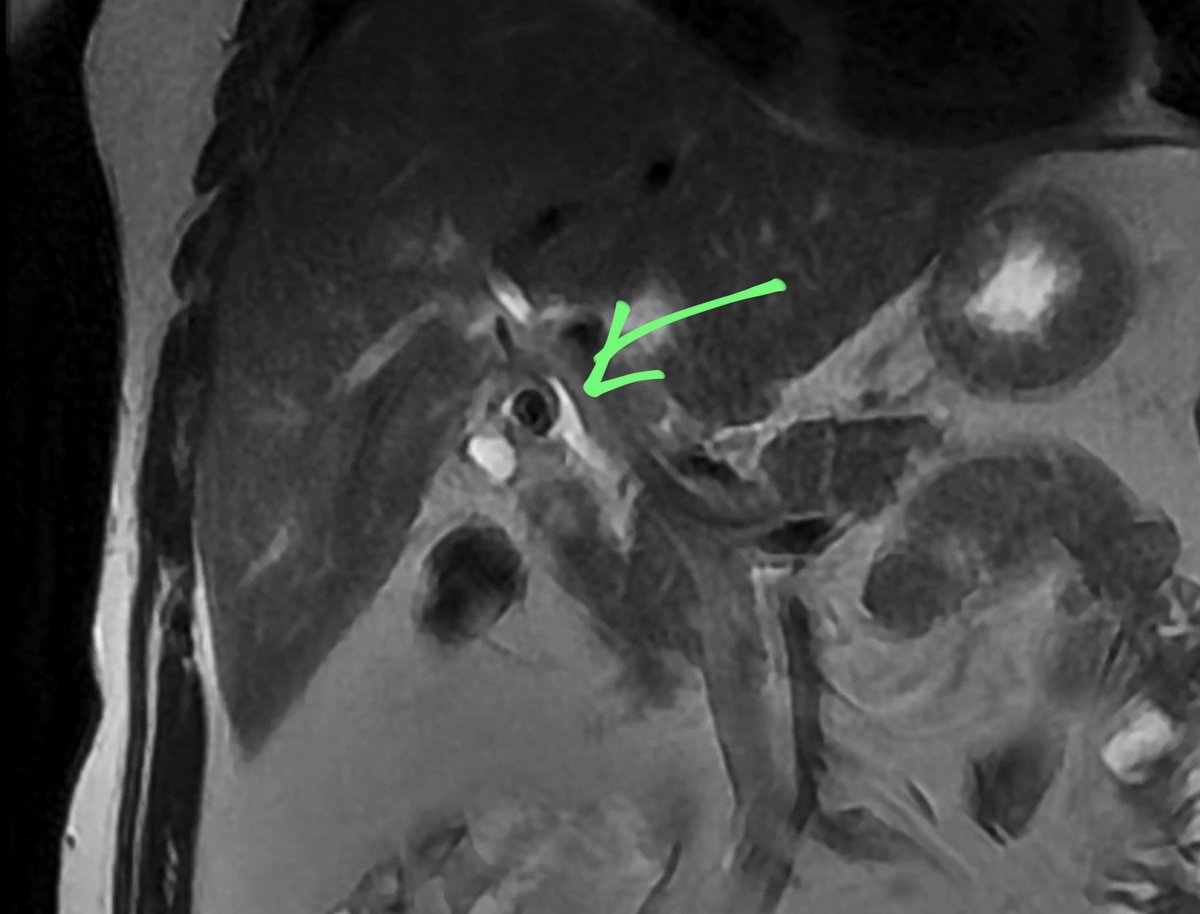 StuckOnASlice's tweet photo. Cystic dict calculus. Condition name ?
#radtwitter #radiologists #radiologyresident https://t.co/d3nmC0Q5QC