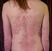 karimanesr's tweet photo. DERMATITIS Y PSORIASIS

La dermatitis y la psoriasis son dos enfermedades inflamatorias de la piel que pueden tener síntomas similares, como enrojecimiento, picor, descamación y costras.

Pero hay algunas diferencias que las distinguen:

La dermatitis puede tener varias causas, como alergias, irritaciones, infecciones o factores genéticos.

La psoriasis es una enfermedad autoinmune, es decir, el sistema inmunitario ataca a las células de la piel por error.

La dermatitis suele afectar a zonas de la piel que están en contacto con sustancias que la irritan o la sensibilizan, como el jabón, el perfume, la ropa o el sudor.

La psoriasis suele afectar a zonas de la piel que sufren fricción o trauma, como los codos, las rodillas, el cuero cabelludo o las uñas.

La dermatitis presenta manchas rojas con bordes poco definidos, que pueden tener pequeñas ampollas o costras.

La psoriasis presenta manchas rojas con bordes bien definidos, que tienen escamas gruesas, secas y plateadas.

La dermatitis suele causar más picor que la psoriasis, que puede causar más dolor o ardor.

La dermatitis puede aparecer en cualquier etapa de la vida, pero es más común en la infancia.

La psoriasis suele aparecer en la edad adulta, entre los 15 y los 35 años.

📌 Guarde🔁 Comparta, hay alguien que necesita esta información.
🫂 Y tiene mucho más contenido de calidad para su salud en mi comunidad y blog (consultas, chat, BioProtocolos...), le espero con los brazos abiertos :)