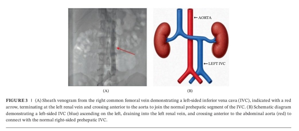 gashawsol's tweet photo. 🫀New Publication Alert!

"Percutaneous Mitral Balloon Commissurotomy in an African Patient With Left-Sided Inferior Vena Cava: A Rare Case Report."

This is the 1st documented successful PMBC in an African patient with a left-sided IVC.

https://t.co/pbegrQfIE7… https://t.co/6UcREUIXMW