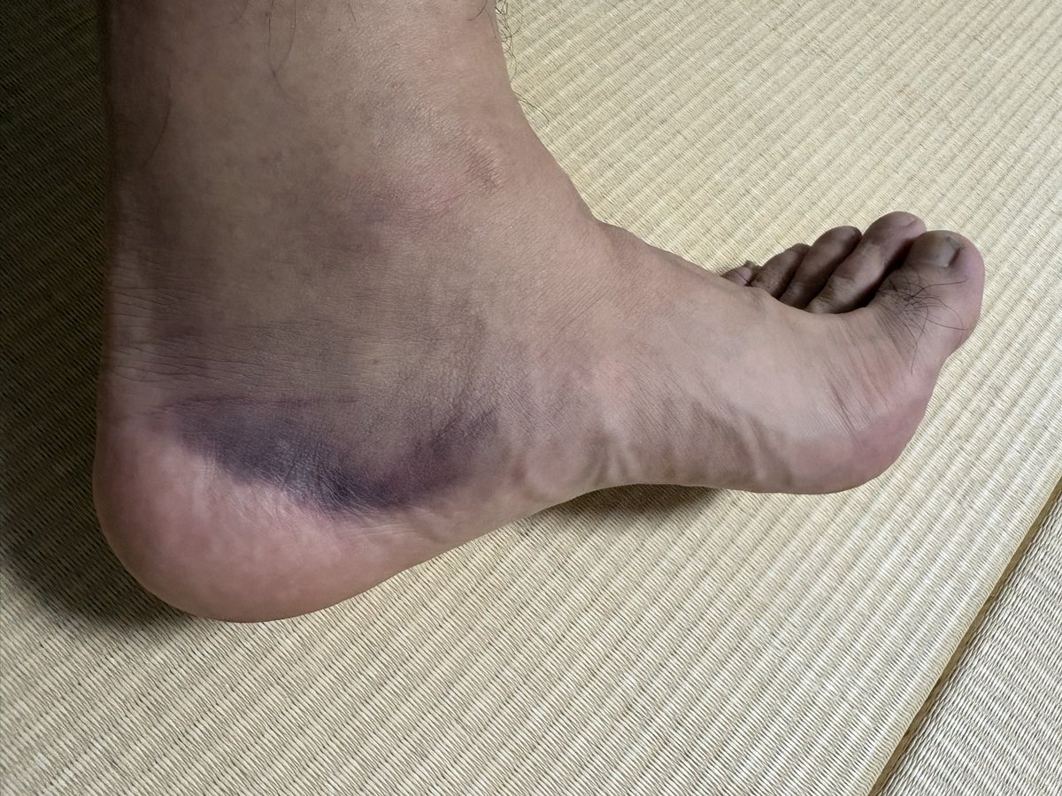 u_knds's tweet photo. 6月終了。ケガ多き月でした。7月はケガない月でありますように。本日は１時間ゆっく〜りと確かめながらジョギング。違和感はありますが…明日は有給休暇
#ランニング
#フットサル
#ふくらはぎ
#内出血
#有給 https://t.co/JuWQUOIubM