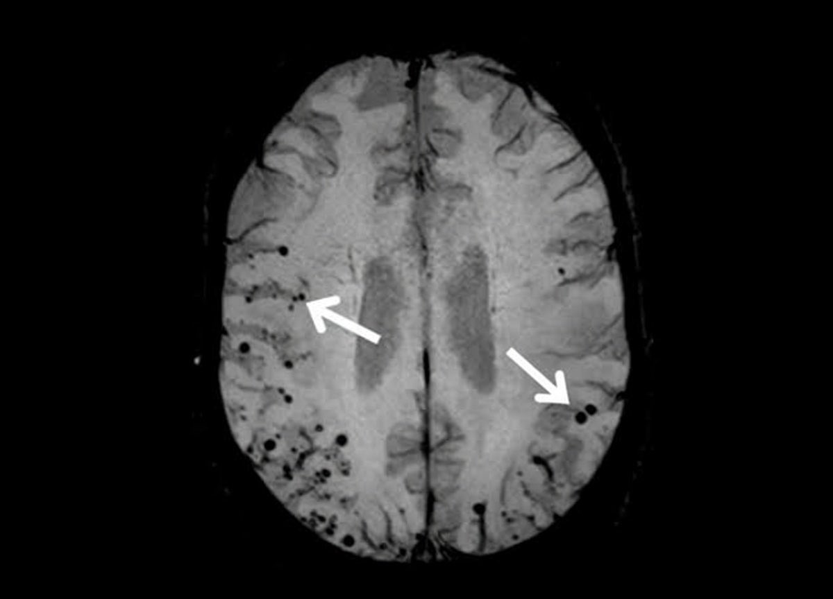 DrAyubaD's tweet photo. EASY ONE 🔥🔥

70-year-old normotensive woman with sudden onset confusion and left-sided weakness.

What is the diagnosis?

#MedX #FOAMrad #NeuroRad https://t.co/rdIRvqwNWh