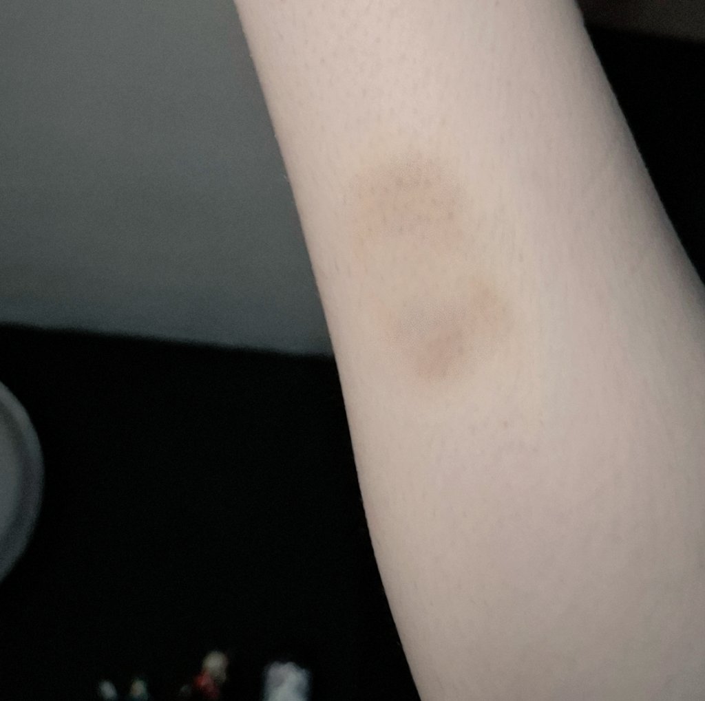 daworstmathlete's tweet photo. bruise on my calf yum https://t.co/0mW6lgswpH