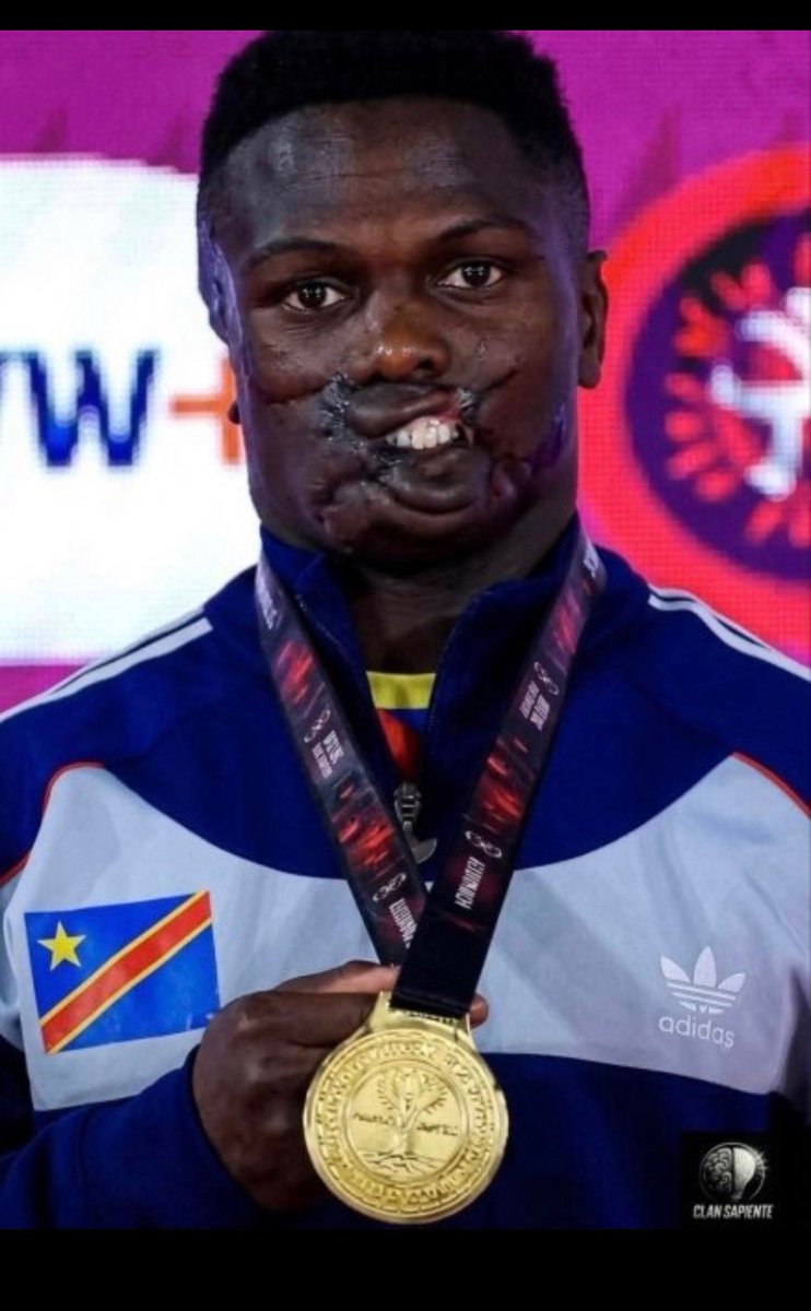 IslaMoons78045's tweet photo. This is not the face of a victim; it is the face of an unstoppable warrior. Dunia Sibomana did not just survive the unimaginable—he has shown the world what he is truly made of. https://t.co/12XS6gQjSA