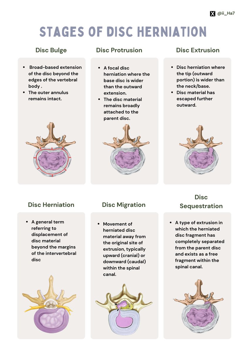 ii_Ha7's tweet photo. ملخص يتكلم عن الـ :
[ Stages of disc herniation ] والفرق بين كل نوع من أنواع الدسك 📄. https://t.co/gbCDZTYLDf