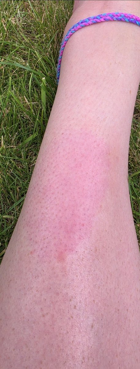 Animalww26's tweet photo. PROOF that Earthing works.
This is psoriasis, 5 days of Earthing for 30 minutes every day apart.
The difference is amazing!
Go Earth yourself!
#clintober #Earthing #Grounding #nature #NaturalSkinCare https://t.co/8p1oq6iTEW