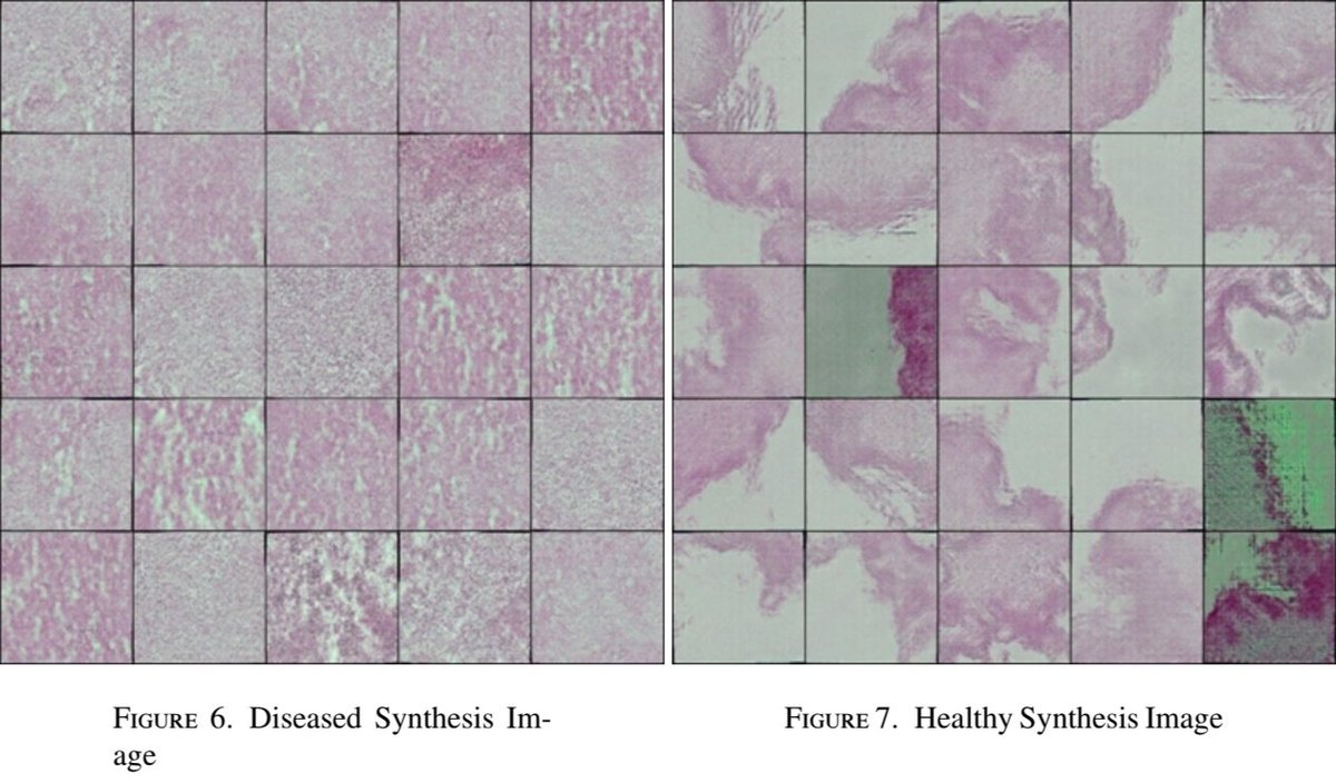 _NilgunSengoz's tweet photo. 📄 New publication!

Delighted to share our latest work on deep learning for histopathological image analysis. The study examines the role of data augmentation and GAN-generated synthetic images in improving classification performance when annotated medical data are scarce.

Published in  #Scopus indexed journal; the Turkish Journal of Mathematics and Computer Science. 

To read the article link is below 🔽🔽
https://t.co/oHX8u4v8PO

#DeepLearning #MedicalImaging #GAN #AI