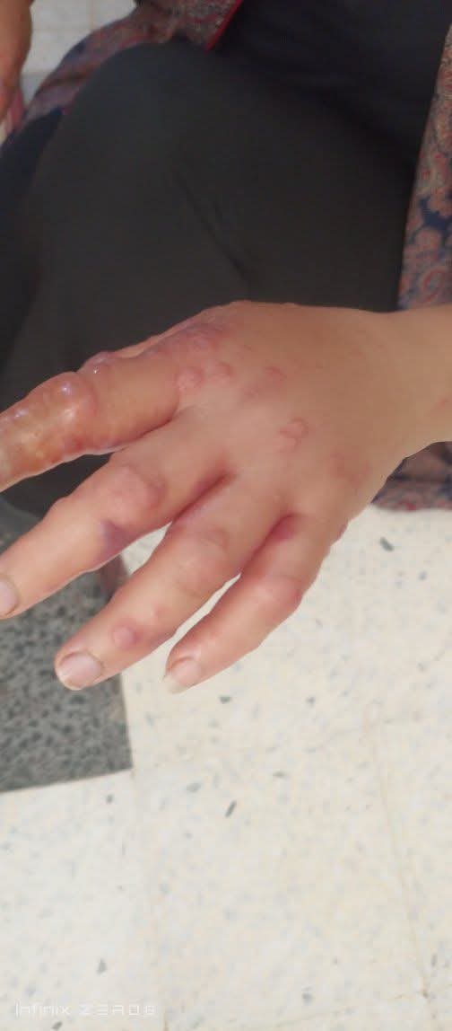 yousefQasem1998's tweet photo. In Gaza, even the mosquito has become part of the daily suffering.
Heat, tents, stagnant water, and harsh conditions make everything harder — even sleep is no longer peaceful.
Yet people are still trying to survive through it all. 😓 https://t.co/bMfAT5XMqX