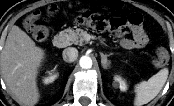 ItaniMalak's tweet photo. Case #22 in 2026  

What do you think of this pancreas? 

#MedEd #rad #radiology #abdrad #abdomen #imaging https://t.co/xobNZAtWof