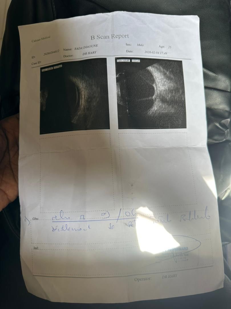 haadijaMouhamed's tweet photo. 🚨 APPEL À LA SOLIDARITÉ 🚨

PARTAGEZ SVP 🙏🏽

«Aujourd’hui, je fais appel à votre générosité du fond du cœur pour mon frère, âgé de 25 ans.

Il est atteint d’un grave problème de vision, et les médecins ont confirmé qu’il doit subir une vitrectomie complexe des deux yeux pour espérer préserver sa vue. Le coût de cette intervention s’élève à 1 500 000 FCFA, une somme que notre famille ne peut malheureusement pas réunir seule.

Dans cette épreuve, chaque geste compte. Quel que soit le montant, votre don peut faire une réelle différence et nous rapprocher de cette opération vitale. Et si vous ne pouvez pas contribuer financièrement, un simple partage de ce message serait déjà une aide précieuse pour toucher d’autres personnes sensibles à notre situation.

💙 Faire un don via Kopar Express :
📱 77 490 12 86

Nous nous engageons à publier les justificatifs médicaux et à garantir une totale transparence sur l’utilisation des fonds collectés.

Merci du fond du cœur à toutes celles et ceux qui nous soutiendront, par un don, un partage ou une prière. Que Dieu vous bénisse abondamment et vous rende au centuple votre solidarité. 🤲🏾❤️»

https://t.co/eO7r0vLntm…