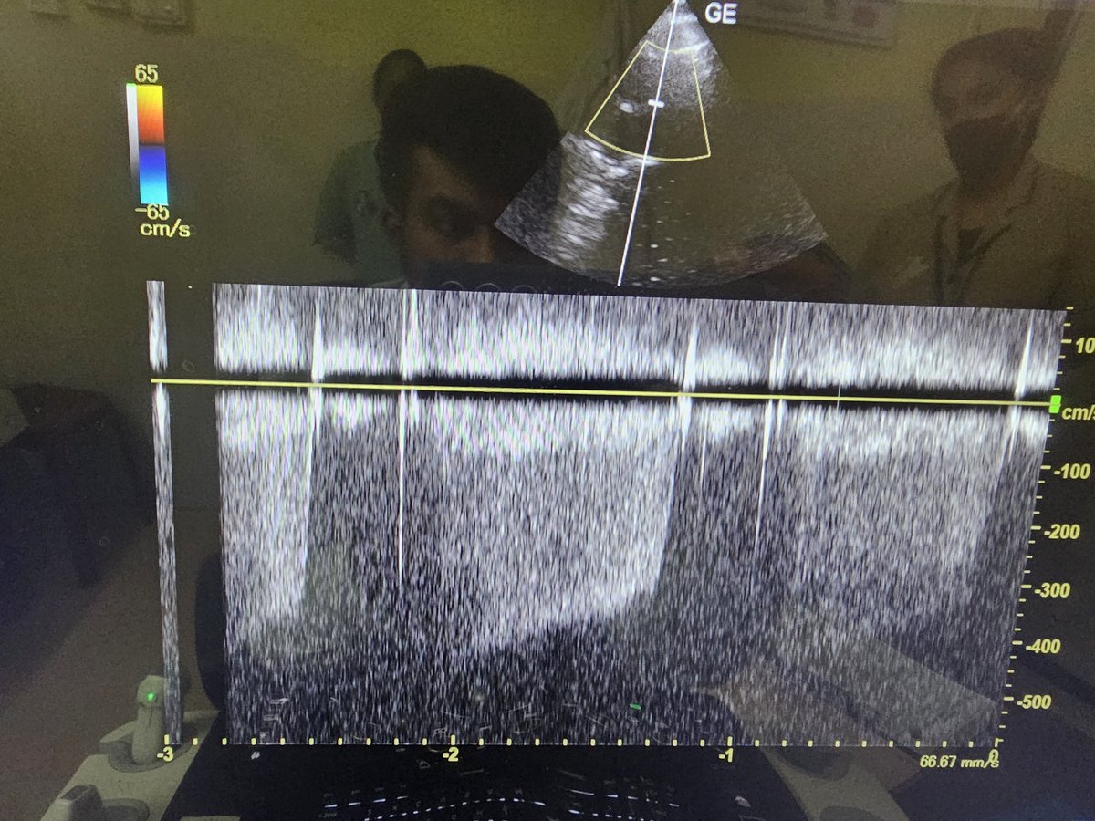 Arvind_JdotA's tweet photo. 20 year old male, assymptomatic, surgically operated for Apical muscular VSD at the age of 11 months. Your Dx?

@TrackYourHeart @ASE360 #cardiopeeps #cardiobot #cardiology #echocardiography
#congenital #CHD #Structural
#TTE https://t.co/mv5yNhQiUL