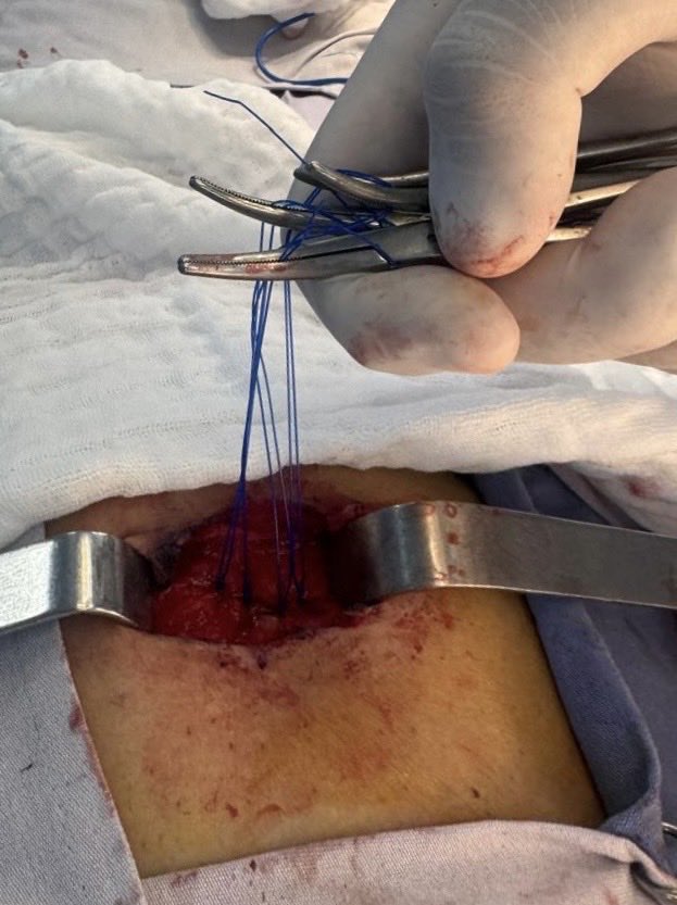 DrJAVazquez's tweet photo. Mínimamente invasivo no siempre significa laparoscopia. Hernia umbilical, insicion en doble flecha. #LaParedImporta #SoMe4Surgery #SoME4IQLatAm #surgicalmentor @BeneTampico https://t.co/TDwm7hmzMn