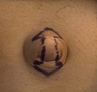 DrJAVazquez's tweet photo. Mínimamente invasivo no siempre significa laparoscopia. Hernia umbilical, insicion en doble flecha. #LaParedImporta #SoMe4Surgery #SoME4IQLatAm #surgicalmentor @BeneTampico https://t.co/TDwm7hmzMn