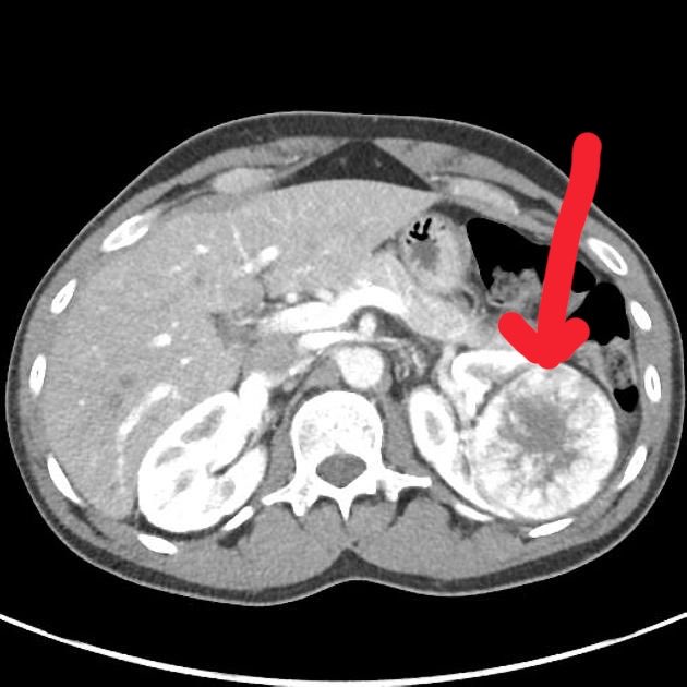 DrAyubaD's tweet photo. 35y Man with Hematuria .

CECT done .

What is the diagnosis?

What are the differential diagnosis? https://t.co/u566LVfXbi